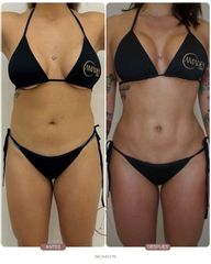 Recambio de implantes + Lipoescultura: renovación y armonía corporal ✨