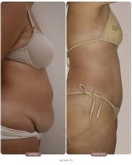 Abdominoplastia + Lipo 360: redefine tu silueta de forma integral ✨