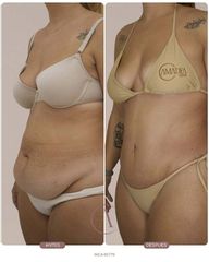 Abdominoplastia + Lipo 360: redefine tu silueta de forma integral ✨