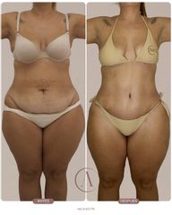 Abdominoplastia + Lipo 360: redefine tu silueta de forma integral ✨