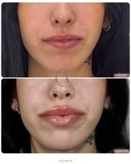 Aumento de labios y marcación de mentón: define tu perfil con armonía