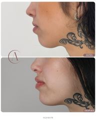 Aumento de labios y marcación de mentón: define tu perfil con armonía