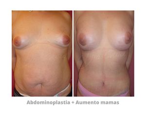 Abdominoplastia + Aumento mamas - Dra. Cava