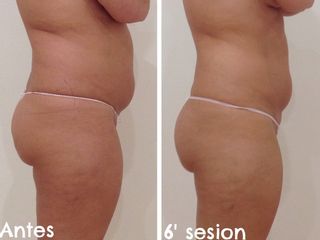 Antes y después Tratamiento reductor de abdomen
