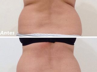 Tratamiento de abdomen pos-parto