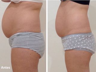 Antes y después Tratamiento de abdomen Pos-parto
