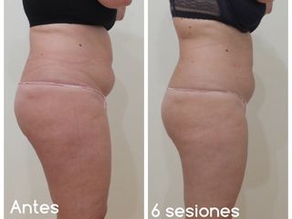 Antes y después Abdomen Imperiun Med 40