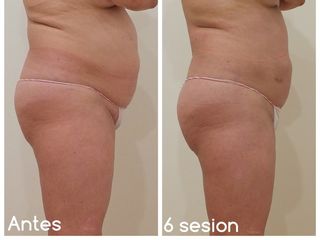 Antes y después mesoterapia
