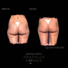 Criolipólisis - Clínica Graziella Moraes