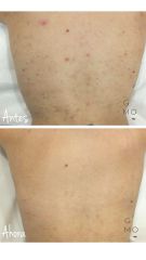 Tratamiento contra el acné - Clínica Graziella Moraes