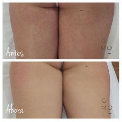 Biodermogénesis para estrías - Clínica Graziella Moraes