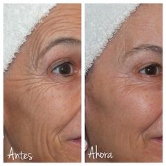 Eliminación de arrugas faciales - Clínica Graziella Moraes