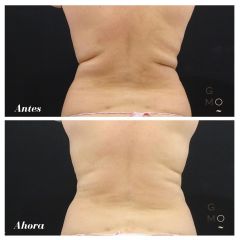 Coolsculpting - Clínica Graziella Moraes