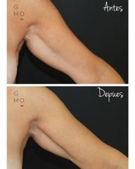 Definición del brazo, Imperium Med  - Clínica Graziella Moraes