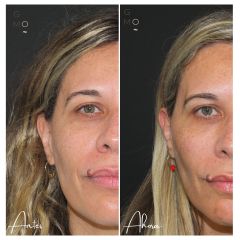 Rellenos faciales - Clínica Graziella Moraes