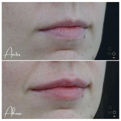 Aumento de labios - Clínica Graziella Moraes
