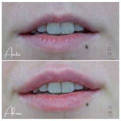 Aumento de labios - Clínica Graziella Moraes