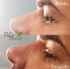 Antes y después Rinomodelación - FLG Clinic