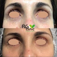 Eliminación de ojeras - FLG Clinic