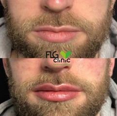 Aumento de labios - FLG Clinic