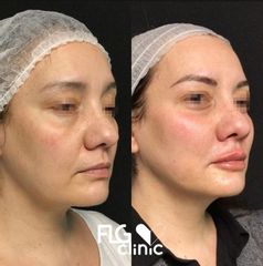Rellenos faciales - FLG Clinic