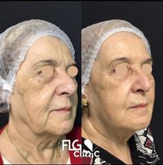 Rejuvenecimiento facial - FLG Clinic