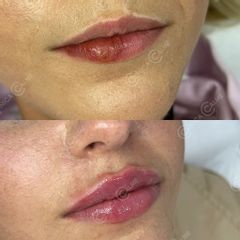 Aumento de labios - Clínica Calme