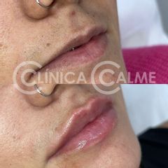 Aumento de labios - Clínica Calme