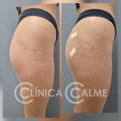 Aumento de glúteos con ácido poliláctico - Clínica Calme
