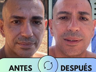 Peeling antes y después - 875522