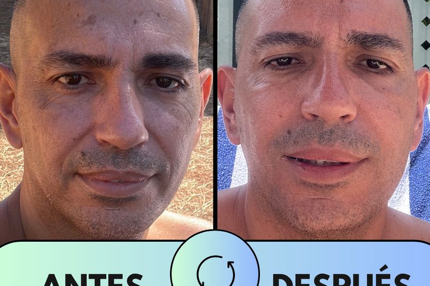 Peeling antes y después - 875522