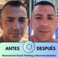 Peeling Quimico - Microxthetic