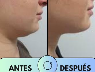 Eliminar grasa localizada antes y después - 876253