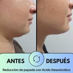 Reducción de papada con Ácido Desoxicólico