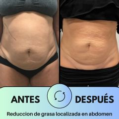 Reduccion de grasa abdomninal sin cirugía