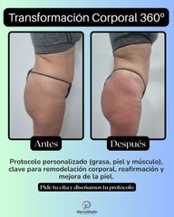 REMODELACION CORPORAL 360