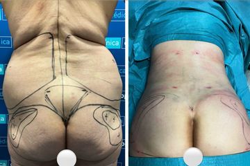 Liposucción - Dr. Felipe Galiano Uribe