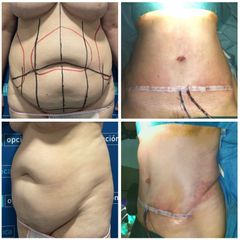 Abdominoplastia - Dr. Felipe Galiano Uribe