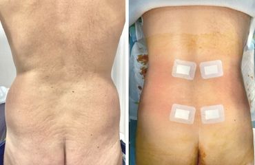 Liposucción - Dr. Felipe Galiano Uribe