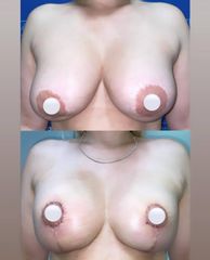 Mastopexia - Dr. Felipe Galiano Uribe