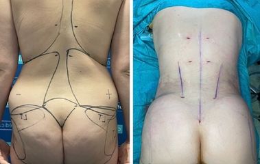 Liposucción - Dr. Felipe Galiano Uribe