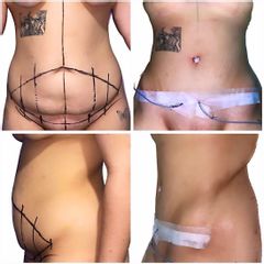 Abdominoplastia - Dr. Felipe Galiano Uribe