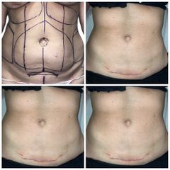 Abdominoplastia - Dr. Felipe Galiano Uribe