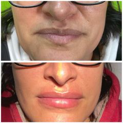 Aumento de labios - Dr. Felipe Galiano Uribe