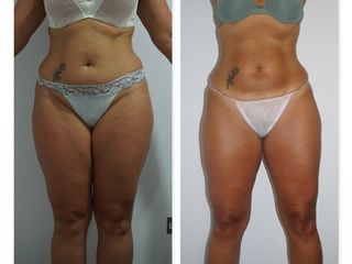 Antes y después LPG