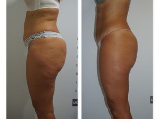 Antes y después LPG