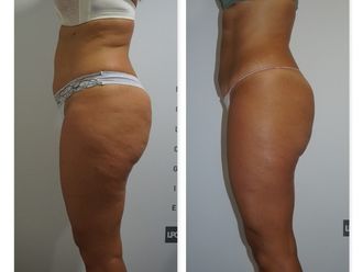 Mesoterapia - 628191