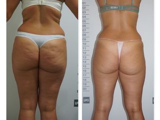 Antes y después LPG