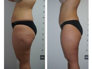 Antes y después LPG