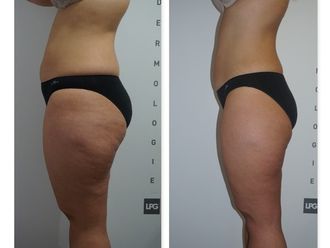 Tratamiento antigrasa - 628195
